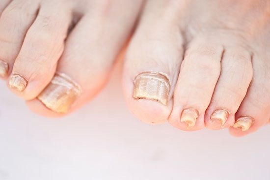 fungus toenail nails does mean