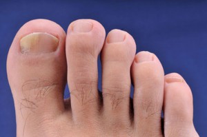 Picture of Beginning Stage of Toenail Fungus