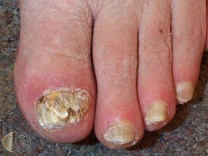 Picture of Advanced, Crumbly Toenail