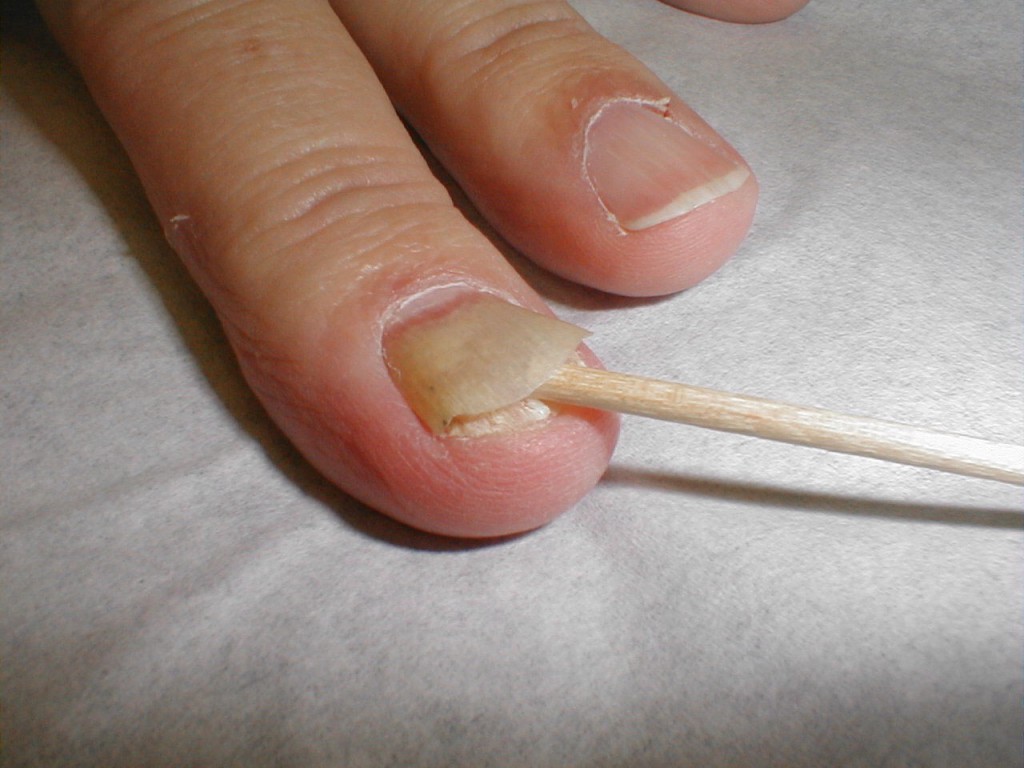 symptoms-of-toenail-fungus-do-you-have-it-fix-ugly-nails