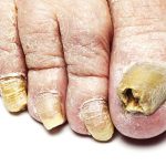 Picture of Thick Toenails