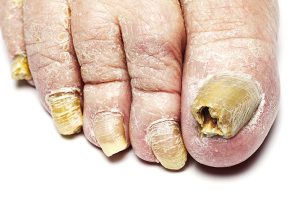 Picture of Thick Toenails