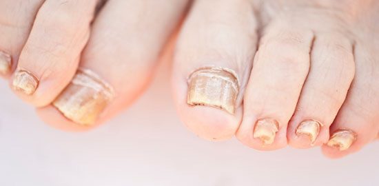 What is Toenail Fungus? - Fix Ugly Nails