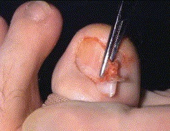 Picture of toenail removal