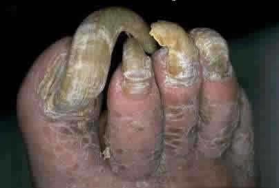 Picture of Ugly Toenails