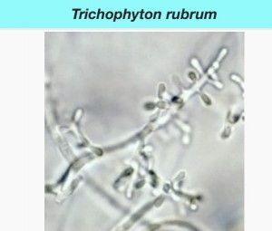 Picture of Trichophyton rubrum - Common Cause of Toenail Fungus