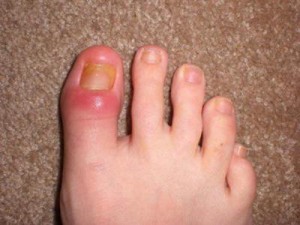 Picture of Cellulitis from toenail fungus