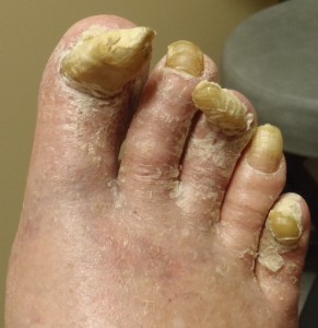 Picture of bad toenail fungus