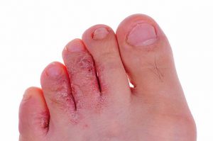 Risk Factors for Toenail Fungus - Foot Fungus