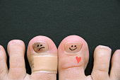 Risk Factors for Toenail Fungus - Injury