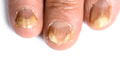 Picture of Symptoms of Toenail Fungus - Fingernails