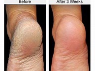 PICTURES OF BEFORE AND AFTER USE OF O'KEEFFE'S FOR HEALTHY FEET