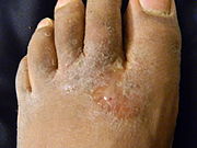 PICTURE OF DRY, CRACKED FEET WITH FOOT FUNGUS ON POST WHAT IS FOOT FUNGUS