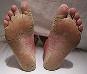 PICTURE OF DRY CRACKED FEET WITH SEVERE FOOT FUNGUS ON POST WHAT IS FOOT FUNGUS