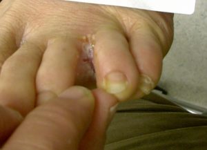 PICTURE OF SCALY FOOT FUNGUS BETWEEN TOES ON POST WHAT IS FOOT FUNGUS