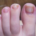 PICTURE OF THICK LAYER OF PENLAC ON TOENAIL