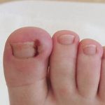 PICTURE OF TOENAIL CUT TOO SHORT