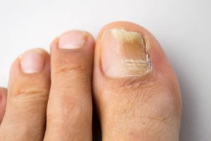 Picture of Toenail Fungus in Attempt to Prevent Toenail Fungus