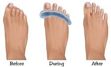 PICTURE OF BEFORE AND AFTER USE OF TOE SEPARATORS FOR OVERLAPPING TOES