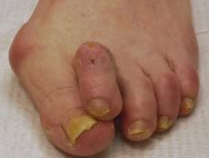 PICTURE OF BUNION AND HAMMERTOES FOR POST TOE SEPARATORS FOR OVERLAPPING TOES