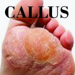 PICTURE OF CALLUS FOR POST CORN VS. CALLUS