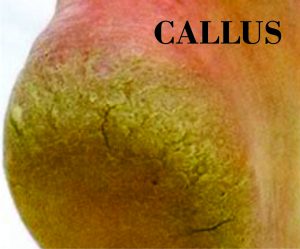 PICTURE OF CALLUS ON HEEL WITH LABEL FOR POST CORN VS. CALLUS