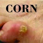 PICTURE OF CORN ON TOE FOR POST CORN VS CALLUS