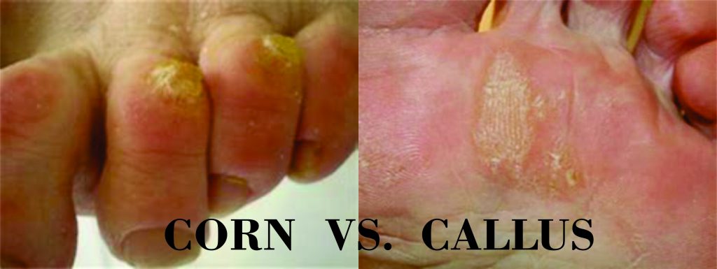 PICTURE OF CORN VS. CALLUS