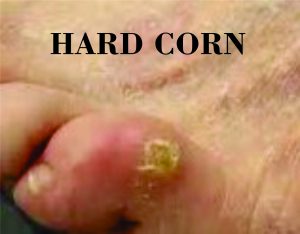 PICTURE OF HARD CORN ON TOE WITH LABEL ON POST CORN VS. CALLUS