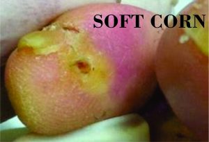 PICTURE OF SOFT CORN BETWEEN TOES WITH LABEL ON POST CORN VS. CALLUS