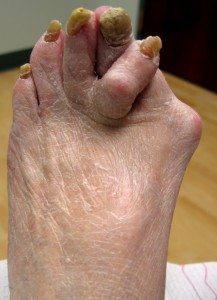 PICTURE OF FOOT WITH SEVERE ARTHRITIS FOR POST FIBROMYALGIA AND FOOT PAIN