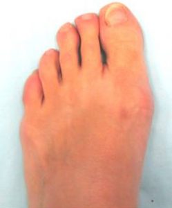 PICTURE OF MILD BUNION FOR POST FIBROMYALGIA AND FOOT PAIN