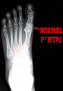 PICTURE OF NORMAL FOOT XRAY WITH WORDS FOR POST FIBROMYALGIA AND FOOT PAIN