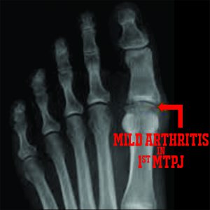 PICTURE OF XRAY WITH WORDS OF MILD ARTHRITIS IN FOOT FOR POST FIBROMYALGIA AND FOOT PAIN