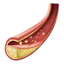 Picture of Artery Lumen Blockage for post Diabetes and Foot Pain