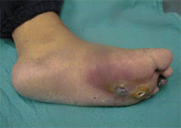 Picture of Infected Ulcer for Post Diabetes and Foot Pain