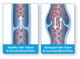 Picture of Venous Valves for Post Diabetes and Foot Pain