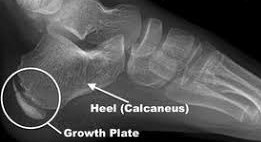 picture of growth plate of heel for post heel pain in kids