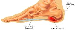 picture of plantar fasciitis for post heel pain in kids