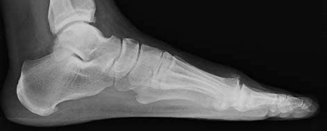 X ray of adult heel for post severs disease in children