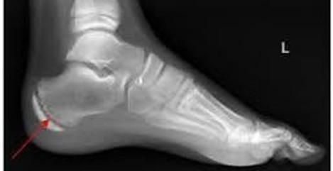 X-Ray of Growth Plate on Heel for Post Sever's Disease in Children